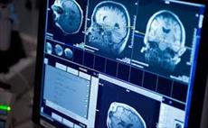 دانلود پاورپوینت ارزیابی خون ریزی های مغزی در MRI - شامل 27 اسلاید