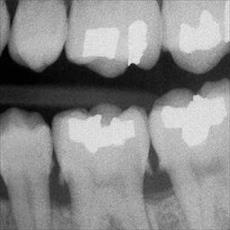 تشخیص عیوب دندان در تصاویر رادیولوژِی و xray با پردازش تصویر همراه دیتابیس و دامیونت لاتین